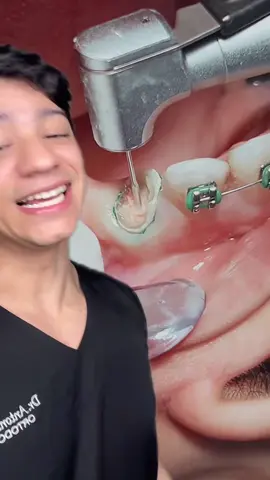 Fazer canal dentário realmente dói? 😰🦷 #dentista