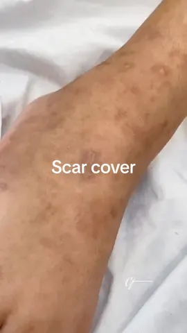 Full coverage for scars #lakerainlegmakeup #scarcoverup #concealer #fyp 