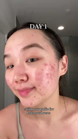 wish me luck 🥹😭 #fyp #viral #trending  #acne #clearskin #relatable 