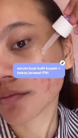serum yg cpt mudarin bekas jerawat pih aku, harus rutin di pakeknya supaya hasilnya maksimal dan glowing🥰👌 #glow #GlowUp #pih #glowbomb #serum #vira #serumviral 