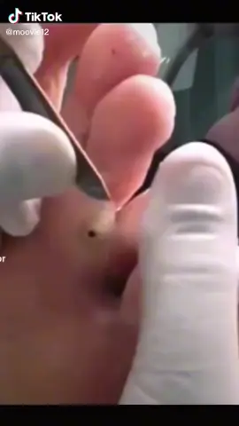 Huge blackhead on foot removal #skincare #pimples #pimplepop #blackheadsremoval #ingrownhair #blackhead #satisfying 