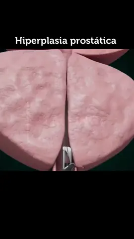 A hiperplasia prostática benigna (HPB), também conhecida como aumento benigno da próstata, é uma condição comum em homens mais velhos, na qual a próstata aumenta de tamanho. Esse aumento pode comprimir a uretra, causando sintomas urinários, como dificuldade em urinar, micção frequente, urgência urinária, fluxo urinário fraco ou sensação de esvaziamento incompleto da bexiga. Causas: A causa exata da hiperplasia prostática benigna não é totalmente compreendida, mas parece estar relacionada a alterações hormonais associadas ao envelhecimento, principalmente ao aumento dos níveis de di-hidrotestosterona (DHT), um subproduto da testosterona. Fatores de risco: Alguns fatores de risco para o desenvolvimento da HPB incluem idade avançada, histórico familiar da condição, obesidade e certos problemas de saúde, como diabetes e doenças cardíacas. Diagnóstico: O diagnóstico da HPB geralmente envolve uma combinação de histórico médico, exame físico, exame de sangue para avaliar os níveis de PSA (antígeno prostático específico) e exames de imagem, como ultrassom ou ressonância magnética. Às vezes, pode ser necessário realizar uma biópsia da próstata para descartar outras condições, como câncer de próstata. Tratamento: O tratamento da hiperplasia prostática benigna depende da gravidade dos sintomas e do impacto na qualidade de vida. As opções de tratamento podem incluir monitoramento ativo, medicamentos para reduzir o tamanho da próstata ou relaxar os músculos da próstata e da bexiga, e procedimentos cirúrgicos, como a ressecção transure  