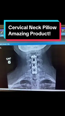 Viral Cervical Neck Pillow!  #Emircey #SleepWell #butterflypillow #fypage #shapoppinwithshannon #spine #spinehealth #neckpain #neckpillow #viralproducts #sleep 