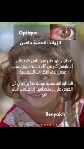 الزوائد اللحمية بالعين، والمعروفة أيضًا باسم البينجويكيولا (Pinguecula) أو ظفرة العين (Pterygium)، هي نمو غير طبيعي للأنسجة على سطح العين. عادة ما تكون غير سرطانية، لكنها قد تسبب تهيجًا وعدم راحة.  #eyes #العين #tips #healthylifestyle #professional #care #SelfCare #صحة #sunglasses #نضارات_شمسيه 