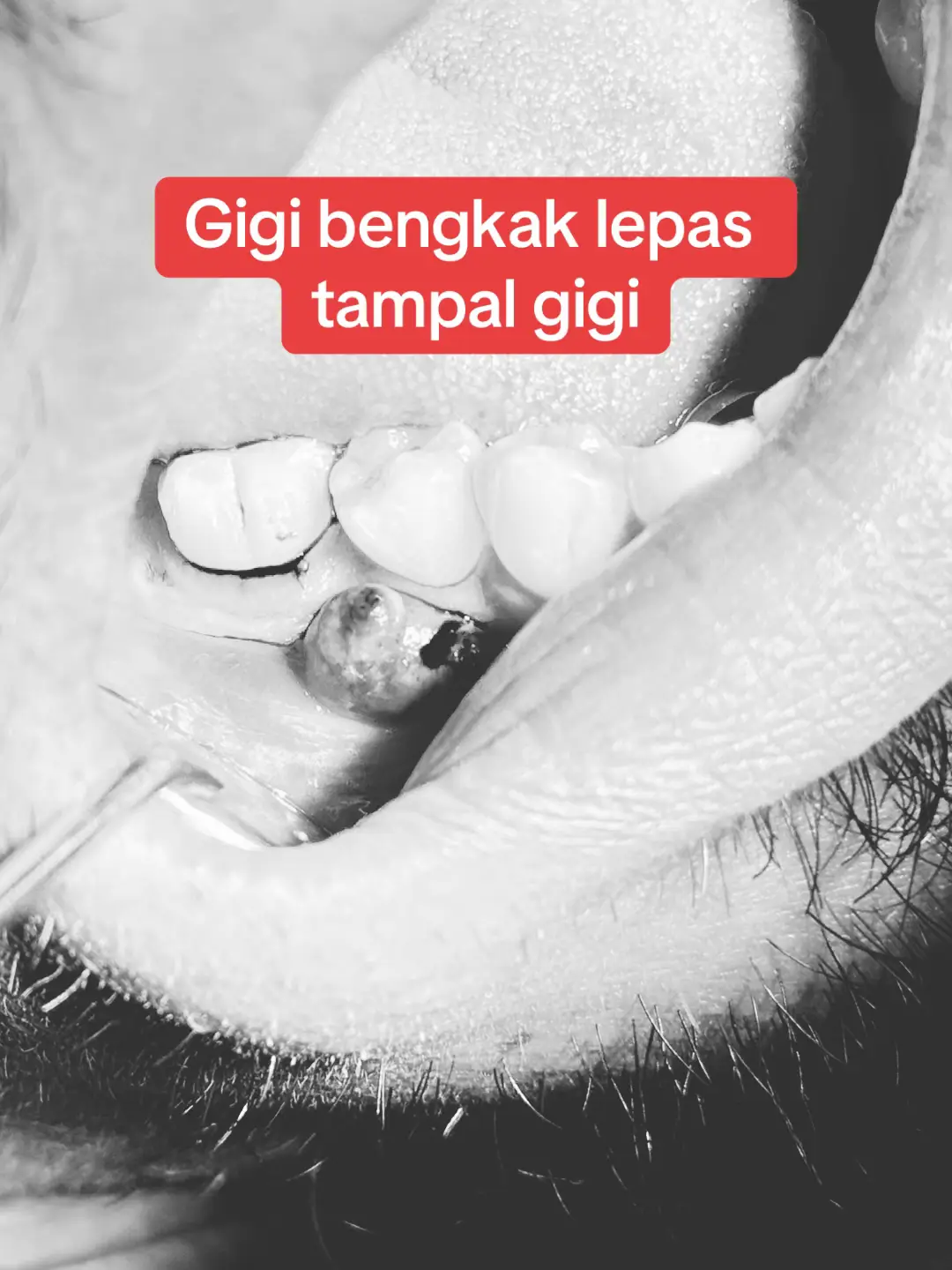 Sebab tu kalau lubang besar, disarankan untuk ambik xray untuk tahu lubang tu dah sampai saraf atau belum. Boleh juga tahu sama ada gigi tu dah ada tanda jangkitan kuman atau belum. Dia doktor selagi tanda dan gejala tak menunjukkan dah samalai saraf contoh ganggu tido malam, bengkak, sakit gigi sangat2, doktor akan anggap belum sampai saraf. Tapi kalau cek xray nampak tanda dah sampai saraf walaupun gejala tak macam kena sampai saraf, confirm lubang tu dah sampai saraf. Dia sennag cerita, xray ni penting untuk confirmkan kes tu. 90% selalu xray sangat tepat untuk pastikan keadaan gigi tu macam mana. #doktorgigi #doktorgigimalaysia #doktorgigijohor #doktorgigipasirgudang #dentistpasirgudang #dentist #klinikgigi #klinikgigipasirgudang #dentalclinic #dentalclinicpasirgudang #sapphiredental #klinikpergigiansapphire #pasirgudangproblem #drqdentistpasirgudang #jbstyle🔥 #jbstylebrader #jbstyle #cabutgigipasirgudang 