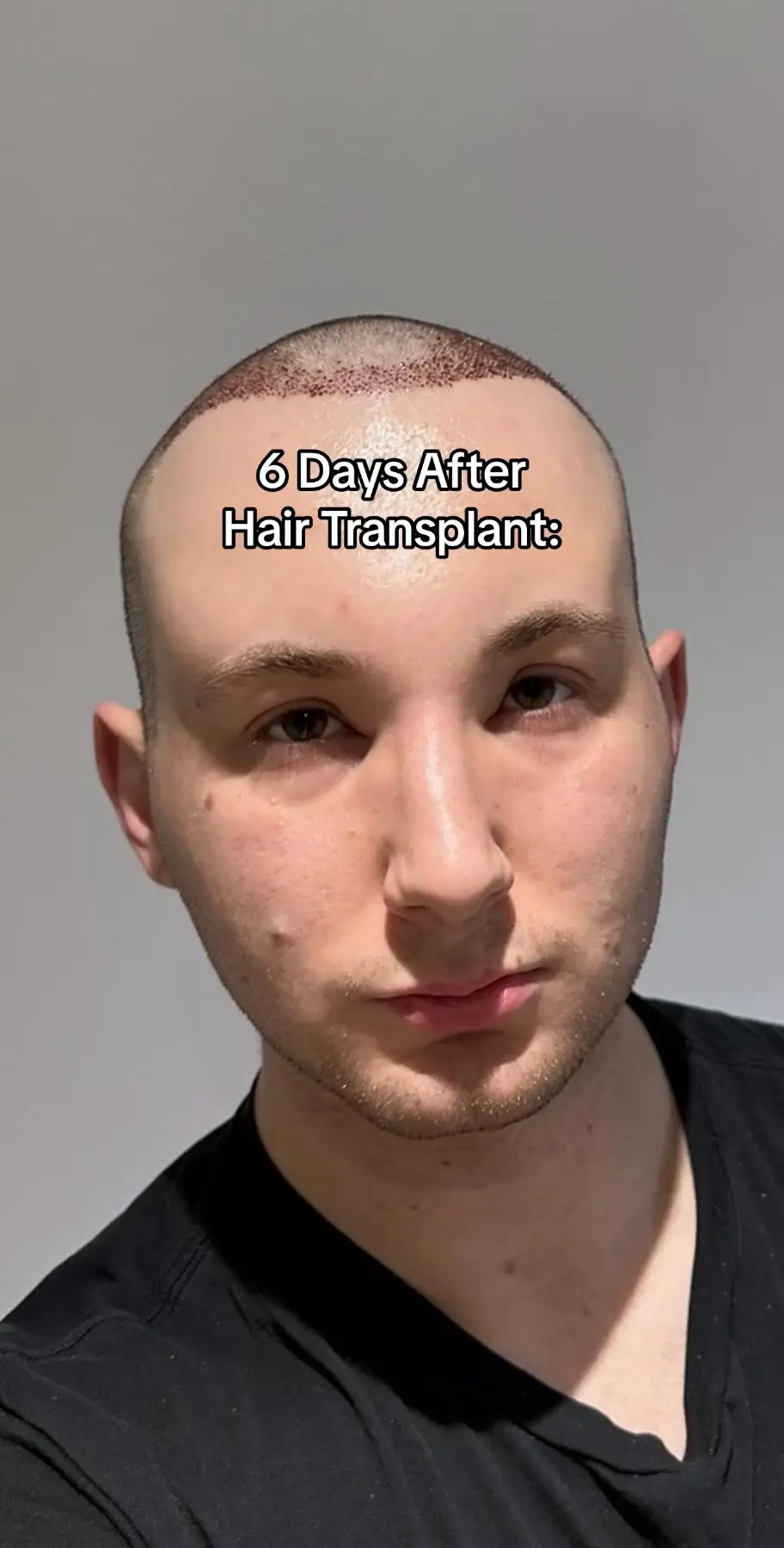 Glowup? Happy 6 month anniversary 😉 #fyp #hairtransplant #hairtransplantuk #hairtransplantlondon #hairtransplantsurgery #recedinghairline #recedinghairlines #hairloss #malehairloss #hairgrowth #hair #grwm #menshair #itsdylanwagner