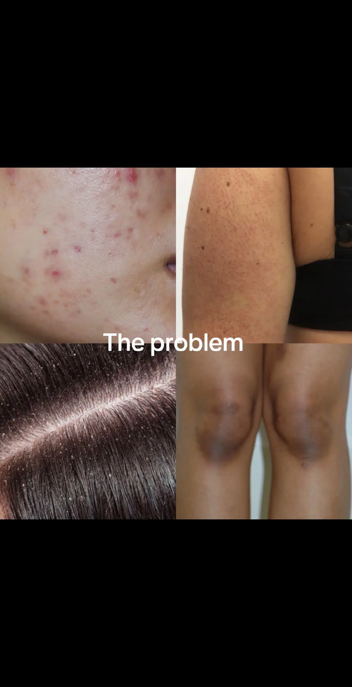 #theordinaryskincare #theordinaryproducts #skintok #acne #skincare