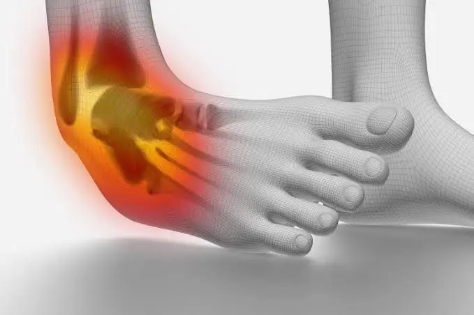 التواء الكاحل ( ankle sprain ) :  هو التواء او التفاف الكاحل بطريقة غير ملائمه مما يسبب تمزق ف الاربطه   #الاسباب :  _ الوقوع الذي يسبب التواء كاحلك _الهبوط في وضعية غريبة على قدمك بعد القفز أو إدارتها _المشي أو التمرين على سطح غير مستوٍ. _أن يدوس شخص آخر على قدمك أو يهبط عليها خلال النشاط الرياضي #الاعراض :  _الم شديد اثناء الوقوف مع الصعوبه ف المشي   _تورم القدم  _احمرار القدم  #العلاج :  _الراحه مع رفع القدم علي شئ مرتفع لتقليل التورم  _استخدام كمادات التلج  _استخدام رباط الكاحل  _استعمال المسكنات ومضاد الاتهاب والتورم  #العلاج الطبيعي :  ليه دور مهم جدا ف تقليل التورم والالتهاب و تقويه عضلات القدم