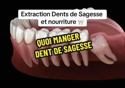 Qu’est-ce qu’il faut manger et quelques conseils après l’extraction des dents de sagesse ? 🦷👨‍⚕️ #dentaire #dentaire #dent #extractions #dentsdesagesses #tiktokacademie #medecine 