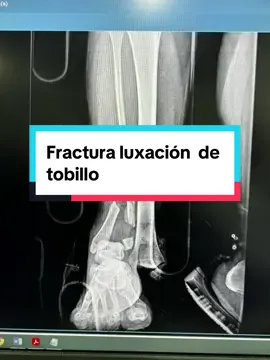 Fractura luxacion, una  de las lesiones mas graves en traunatologia …#fracturadetobillo #luxaciondetobillo #traumatologia #coyoacan #tlalpan #tlahuac #xochimilco 