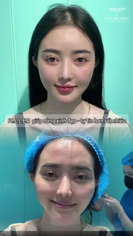 Điều giúp tôi tự tinn hơnn là đây ➡️ @Chauhuyen_Beauty #huyenchaubeauty #tranhuyenchau #filler #xuhuong 