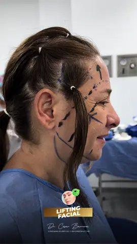 ¡Mira la increíble transformación con nuestro lifting facial! Descubre cómo hemos rejuvenecido su rostro, devolviéndole firmeza y frescura. ¿Quieres verte y sentirte más joven? No te pierdas este asombroso antes y después y da el primer paso hacia una nueva tú. #lifting #liftingfacial #cirugia  #cirurgiaplastica