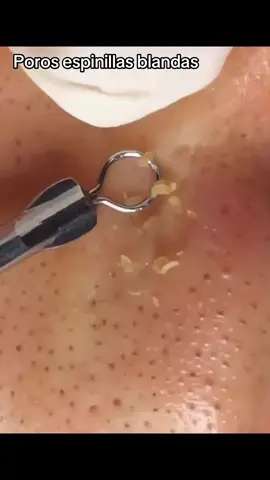 #extractions #puntosnegros #acne #grasa #espinillas #granos #poros #pelo #Folículo #relajante #facial #extraccion 