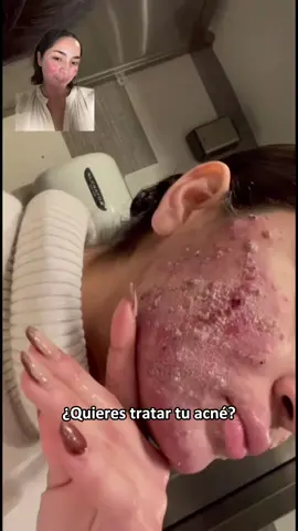 Más vendida, Crema de Caracol VGO Hidrata, Ilumina, Mejora la opacidad, Apto para todo tipo de piel #cremadebadecaracol #caracolmucina #caracol #cremaparalacara 