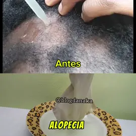 Sofre de alopecia e queda acentuada de cabelo? Descubra essa solução caseira incrível! Fortaleça os fios, melhore a circulação no couro cabeludo e combata a caspa de forma simples e natural. Recupere seu cabelo com um ingrediente poderoso que você já tem na cozinha! 🍲🧅💪. #cabelo #alopecia #quedadecabelo #crescimentocapilar #alopeciaareata #receitacaseira 