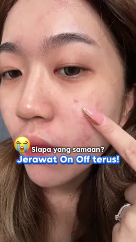 Siapa yang samaan? Jerawat On Off terus 😭 Cobain deh @La Roche-Posay Indonesia  Effaclar Duo+M ! Moisturizer Efektif banget melawan jerawat! #LaRochePosayID #SkinLifeChanger