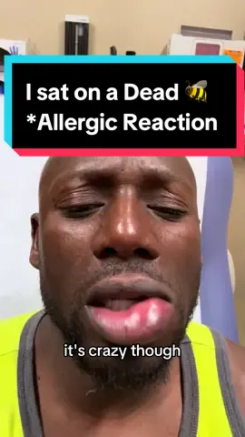 I had an allergic reaction to a bee sting😩. Obviously i wad okay byt it ruined my day with the quickness lol.  @Credit Coach Jen @Dr. Rubin, MD #allergy #epipen #er #allergic #hives #swelling #bee #reality #realityshow #unscripted #funny #scary #emergency #nurse #medicaltiktok #fail #emergencyroom #anaphylaxis 