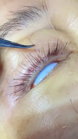 Eyelashes transplant #eyelashes #wimpern #cílios #pestañas #pestañaslargas #pestañaspeloapelo #eyelashestutorial #eyelashtransplant #eyebrows #eyebrowtransplant #hairtransplant #hairtransformation  #hairtransformation #aesthetic #aestheticmedicine #aestheticmed #aestheticdoctor #aestheticnurse #aesthetictreatments #medicalevent #fda #injectables #beautytherapy #microblading #эстетический #estética #estéticaautomotiva #ästhetisch #esthétique #esthétiquemédical #estetiske #estetický #естетски #estetica #estetista