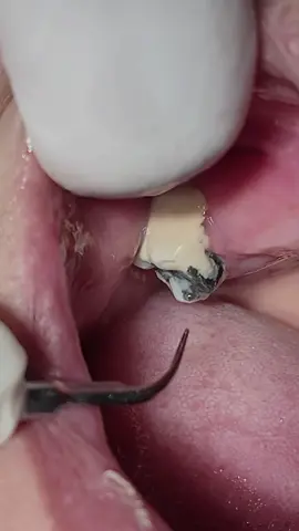 Scaling calculus and tartar #dentist #teeth #dental #tartar #calculus #dentista 