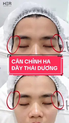 Cân chỉnh HA cải thiện lõm hóp vùng thái dương chỉ với 15 phút cùng bác sĩ HER #spa #skincare 
