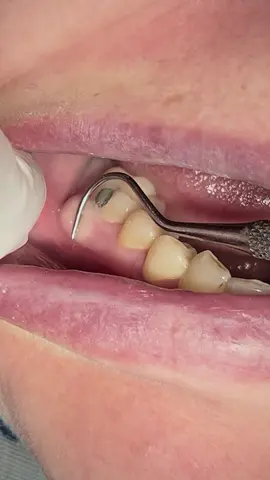 tooth abscess #dentist #teeth #dental #tartar #calculus 
