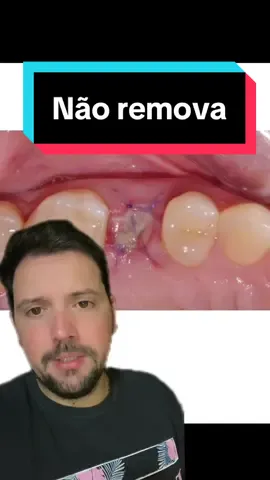 NÃO CUTUQUE.  NÃO REMOVA.  Isto é tecido de cicatrização. #boca #dente #dentista #odontologia #sorriso #siso 