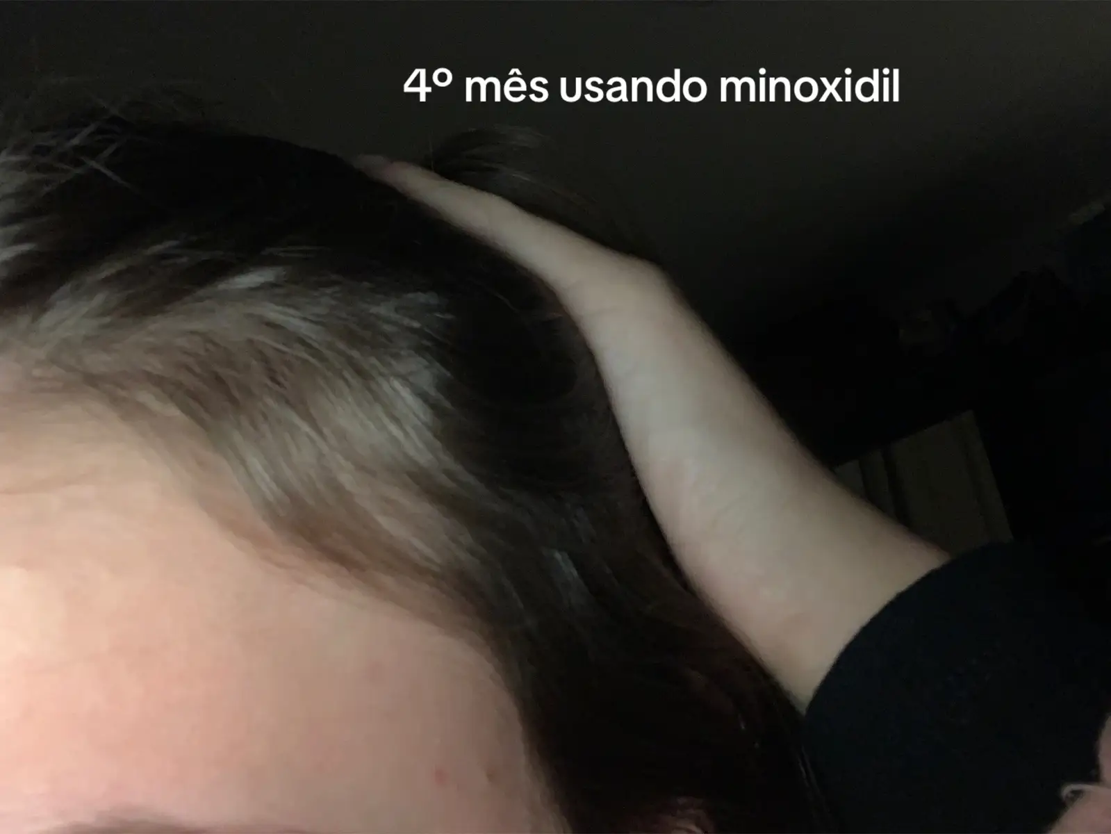 me expondo de graça aqui🤙🏻 #minoxidil 