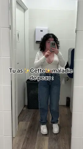 Voici les « bémols cachés »du ✨Vitiligo✨dont personne ne parle  *La desquamation, c’est la peau qui pèle. #vitiligo #maladie #coupdesoleil  #viral #fyp #vitiligogirl #brulure #autoimmunedisease #vitiligobeauty 