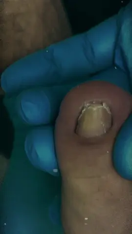 unha encravada #toenail #巻き爪 #nails #unhaencravada #ingrowntoenail 08