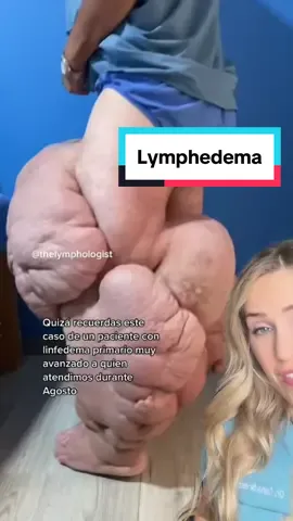 #duet with @Luis Lopez Montoya what an amazing transformation!  #lymphedema #AprendeEnTikTok #doctor #doctorreacts #doctorsoftiktok #learnsomethingnew #medical #surgery #medicalvideos #doctors #podiatry #podiatrist #footsurgeon #surgeon #surgeons #nurse #nurses #healthcare #scrublife #medicalhumor #scrubslife #podiatric #medicine 