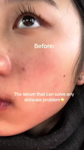 Bean using this product for a while😁 I used it again and this is the result after 2-3 weeks. (X1 exfolaiting a week) It solves my skin texture and forming acne everytime. Its texture is so cool and it has two functions🤍 multi use for multiple skin provlems! Its also vegan #fyp #kbeauty #koreanskincare #skincare #glassskin #essence #serum #mixsoon #glowyskin #skintips #koreanbeauty #texturedskin #acne 