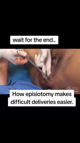 Episiotomy is a surgically made perineal incision when there is delayed second stage.it reduces birth asphyxias #foryoupage #fyp ##birth #mothers #episiotomy 