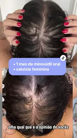Vocês acham que deu diferença? #calviciefeminina #alopeciandrogenetica 