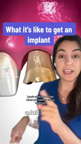 Getting an implant to replace a missing tooth! #dentist #dentalimplants #toothless #toothextraction #smilemakeover bg vid: @Zack D. Films 