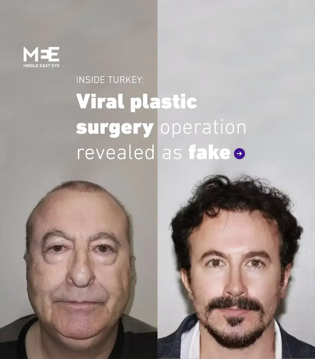 Seemingly miraculous before-and-after photos of a plastic surgery operation in Turkey have been discovered to be of two different men. The images showing the supposed before and after of an operation allegedly performed on an American tourist in Turkey was widely circulated due to the dramatic transformation it appeared to depict. It was hailed as proof of the skill of Turkey’s plastic surgeons, who have been in high demand in recent years as medical tourism has increased in the country. However, some raised suspicions about the plausibility of the images, with people questioning if they depicted the same person. Turkish TV channel Ekol TV tracked down the man in the “after” image, revealing his name to be Engin Demir, not Michael, and that he is a Turkish citizen. “I am not the person in this news. I did not have a face transplant,” he told the channel, adding that he had undergone a different surgery four years ago. His image was posted alongside another man’s on the Instagram account of EstemedIstanbul, which has over 600,000 followers and regularly posts before-and-and-after images of patients who underwent their procedures. Demir said he would be taking legal action as a result of the image. “My phones have not stopped ringing. Messages keep coming in. I am tired of answering,” he said. “Enough is enough. I’m bored.” Turkey is one of the top ten destinations for medical tourism globally, with 600 registered clinics in Istanbul alone, according to Patients Beyond Borders (PBB), an organisation that surveys medical tourism. Local media reports indicate that more than 100,000 people, the majority from Arab states, visit the country for hair transplant procedures alone. Advertisements for cheap operations in Turkey are regularly peppered throughout social media, particularly on image-sharing sites such as Instagram. ✍️ MEE/Alex MacDonald