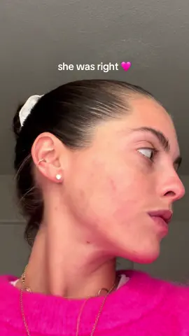 Heres your sign to take photos & videos of your skin when its at its worst because it WILL get better 🩷 #itgetsbetter #acne #adultacne #hormonalacne #cysticacne #skintransformation #texturedskin #acnescar #acnefighter 