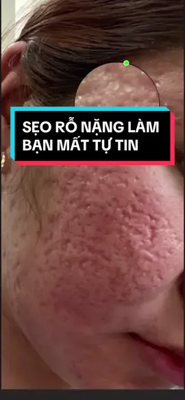 Phân tích một tình trạng da sẹo rỗ nặng và cách điều trị #hoangduongdieutriseo #sẹo_lõm #sẹo_rỗ #dieutriseoro #seo 