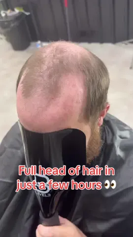 Non surgical men hair replacement 👀 #menshairtoupee #menshairsystem #hairtutorial #barbershop #transformation #menshairreplacement #hairlosssolutions #skinfade #GlowUp #hairstyle 