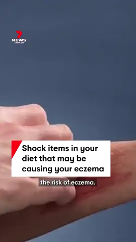 A new US study suggests a diet high in sodium, or salt, might increase the risk of eczema. #eczema #dermatitis # salt #sodium #7NEWS