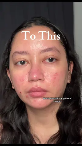 Lagi cobain serum jerawat buat ngilangin sisa2 masa penjajahan pms wkwk ternyata ampuh juga si @Scarlett Whitening Official acne serum ini.. murah bgt lagi #pejuangjerawatapproved #acneserum #scarlettwhitening 
