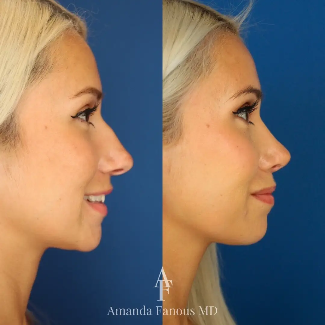 In this rhinoplasty, the goal was to bring down the dorsal hump and subtly increase the tip rotation to create an elegant nose that suits her delicate features perfectly.  A less spoken about aspect that goes into creating the perfect side view is create the perfect supratip crease. If the crease is too deep, the tip will look completely separate from the rest of the nose, creating an unnatural result. If the crease is absent, then there is no delineation between the tip and the dorsum, creating droopy appearance - which we do not want! That being said, creating the perfect supratip is all about balance ⚖️ #mtltiktok #rhinoplasty #rhinoplastybeforeandafter #postop #plasticsurgery #nosejob #facialplasticsurgery #nosejobcheck 