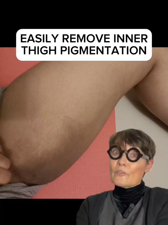 How to easily remove #innerthighpigmentation #hyperpigmentation #hyperpigmentationtreatment