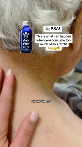 📢‼️ Don’t let this happen to you! Feel Free Drinks are highly addictive and this is how it affects your skin…watch out! 😳🫣 #psa #skincare #skinhealth #dermatologist #icthyosis 
