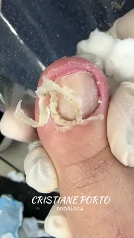 🤤| QUANTA PELE QUE SAIU ! PEELING SATISFATÓRIO . #podologacristianeportopodologa #cristianeportopodologa #satisfatório #paravocê #peeling #dormir #brasil #brazil #podologia #podologo #podologa #foryou #fyppppppppppppppppppppppp #peelinggel 