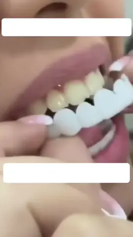 Aprovecha nuestra oferta solo 59.900$ ¿estás cansado de tener una sonrisa poco atractiva? ) Las carillas dentales son la solución perfecta para ti. Sin dolor, sin interrupciones, y en poco tiempo podrás tener la sonrisa que siempre has deseado. ¡comienza a lucir una sonrisa radiante! más info acá 👇 https://www.lunanovams.com/products/carillas-dentales #viral #saludbucal #carillasdentales #diseñosonrisa #dentadura 