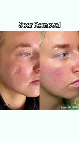 Scar treatment on our beautiful patient: Morpheus8 + dermal filler 🩵✨  Each patient is different and we are able to customize treatment plans to address specific concerns. Loving this patient’s results. 😍 📱 818-308-7274 |📍 Studio City, CA #scartreatment #scarremoval #scarring #reconstructivefiller #morpheus8 #skincare #aestheticPA #cosmeticwork #aesthetics #studiocity #renumedlounge