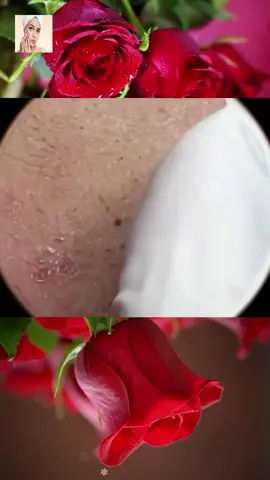 #squeeze #squeezeyuk #acne #pimple #pimplepop #blackhead #satisfying #foryoupage