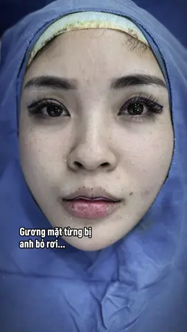 Gương mặt từng bị anh bỏ rơi… #catmi #phauthuatthammy #benhvienthammykangnam 