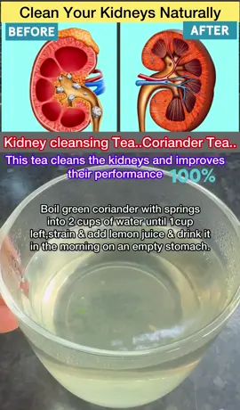 Kidney cleansing Tea..Coriander Tea.. This tea cleans the kidneys and  improves their performance💯👌 A handful of green coriander, 2 cups of water, 1 lemon, Boil green coriander with springs into 2 cups of water until 1cup left,strain & add lemon juice & drink it in the morning on an empty stomach. Coriander tea is very useful in problems like kidney pain, dark urine, painful urination, urinary incontinence, kidney stones. People who drink a lot of cold drinks should drink this tea to cleanse their kidneys To avoid kidney problems. #kidney #health #healthcare #SelfCare #remedy #foryou #fy #fyp #foryoupage 