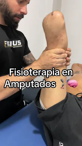 La amputación proporciona nuevos patrones de marcha y de carga, y pueden generar lesiones por sobrecarga o falta de uso.  La fisioterapia es fundamental, para mantener una buena funcionalidad estructural global.  #amputados #movilidadreducida #silladeruedas #protesisdepierna #rehab #physiotherapy #fisioterapia #rehabilitacion #dolordeespalda #accidente #viral #lesiones #lesiones #fisius 